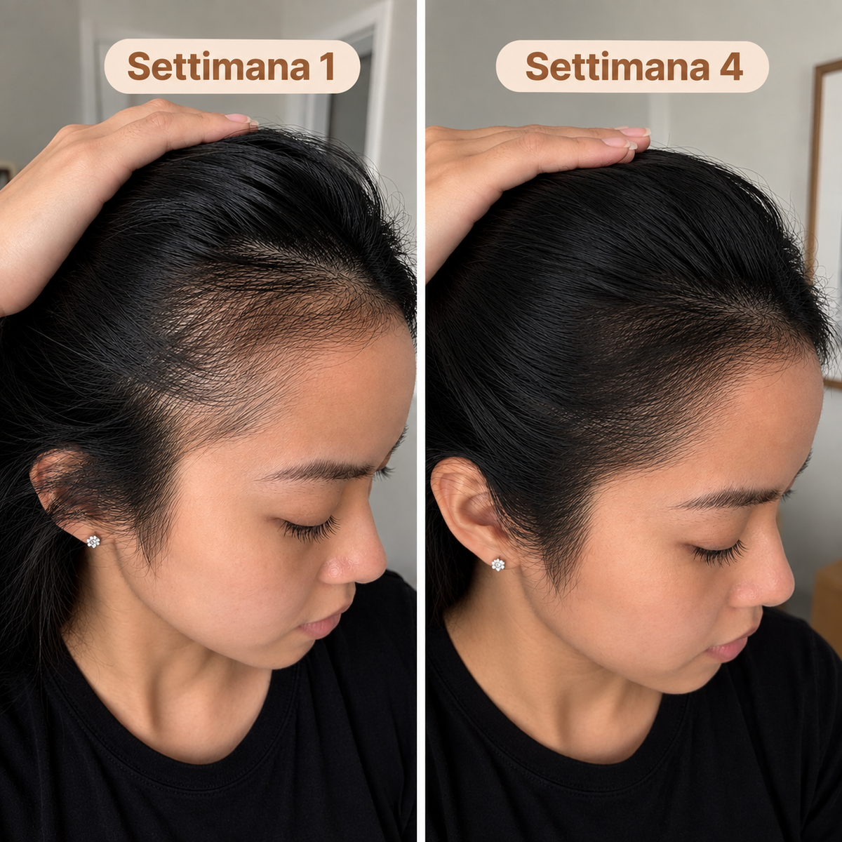 LUMEA™ Fermati la Caduta. Fai Ricrescere i Tuoi Capelli
